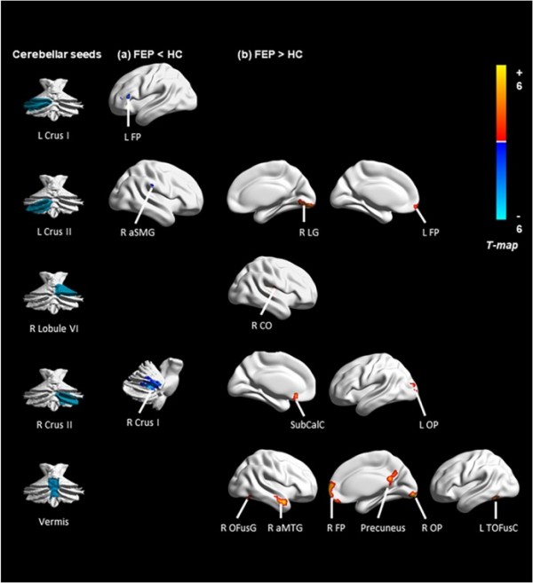 Altered intrinsic cerebellar-cerebral functional connectivity is ...