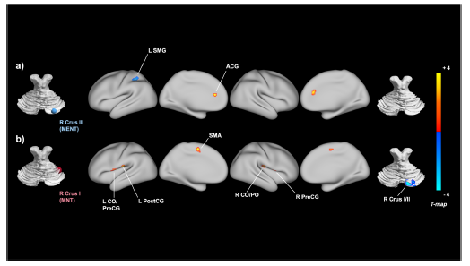 Intrinsic cerebellar functional connectivity of social cognition and ...