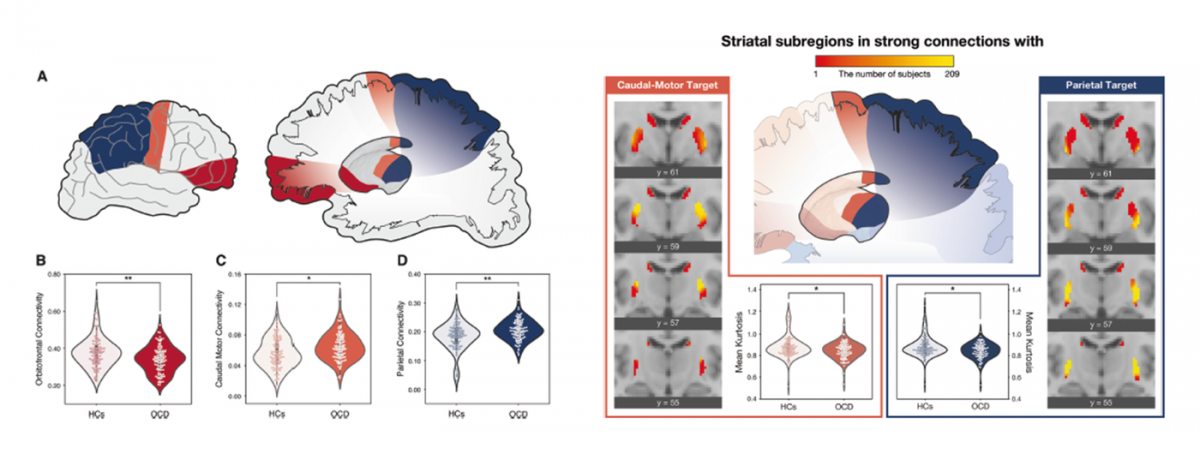 Striatal white matter connectivity and microstructure in OCD