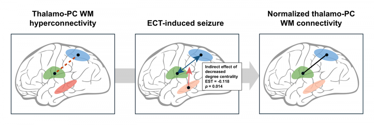 Thalamo-parietal white matter connectivity before and after ECT in schizophrenia spectrum disorder