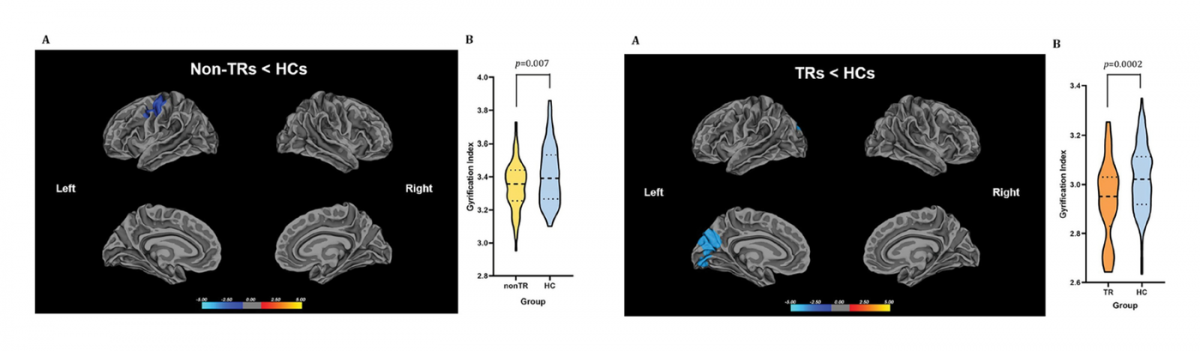 Cortical gyrification and treatment resistance in first-episode psychosis